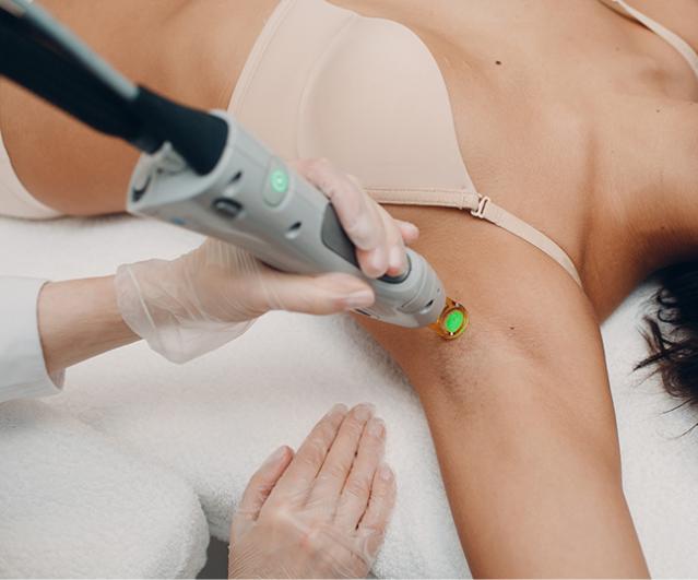 épilation définitive au laser
