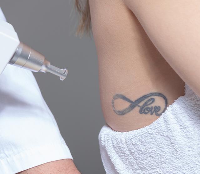 détatouage laser